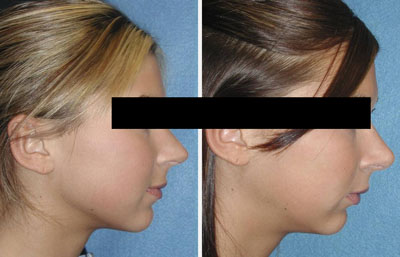 what is a nose job