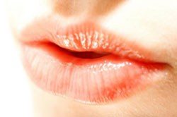 Restylane for lip augmentation