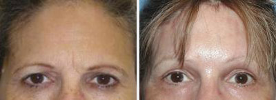 brow lift before and after