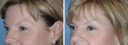 blepharoplasty photos