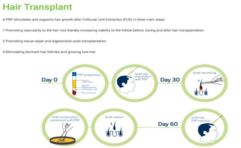 Hair Transplant diagram of 60 days after NeoGraft® treatment