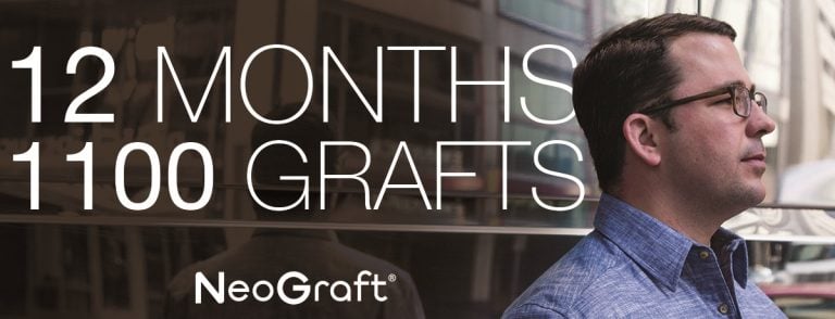 12 months, 1100 Grafts - NeoGraft®