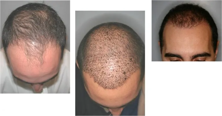 Before and After NeoGraft®