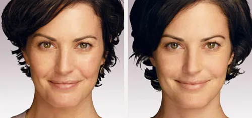 Juvederm® Before and After