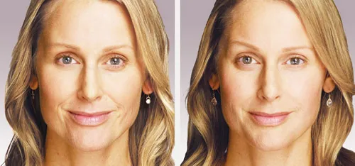 Juvederm® Before & After 