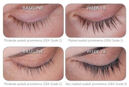 Before and After photos of eyelashes with Latisse® treatment