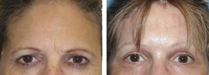 Before & After Brow Lift, Case Study photos