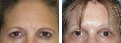 Before & After Brow Lift, Case Study photos