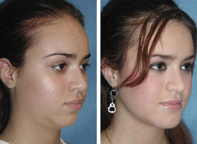 Before and After Facial Implant Surgery Cleveland