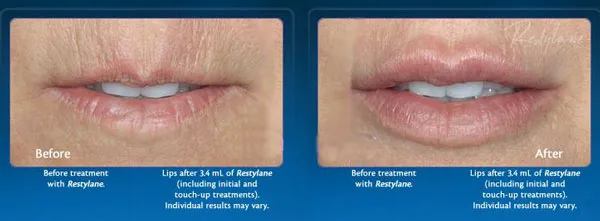 Lip augmentation with Restylane, before and after injections with a filler
