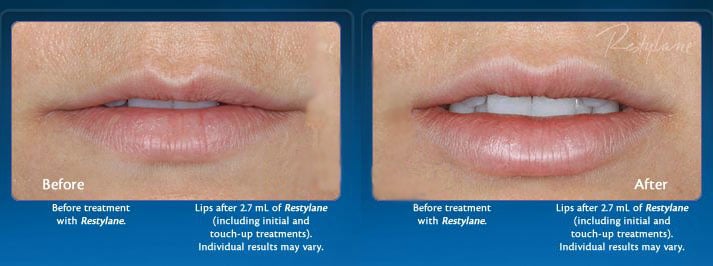 Lips - Before & After Restylane