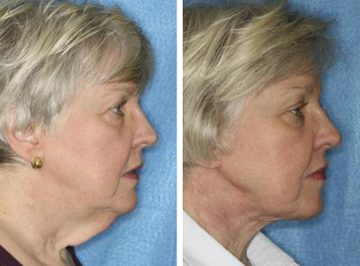 Before and After Neck Lift performed by Cleveland area (Medina) Facial Cosmetic Surgeon