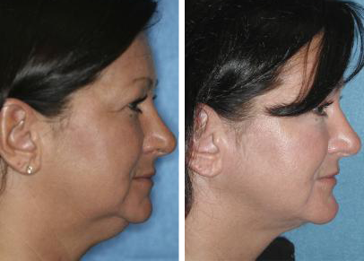 Before and After Neck Liposuction Cleveland