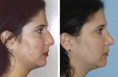 Before and After Rhinoplasty photos by Cleveland area (Medina) Facial Cosmetic Surgeon