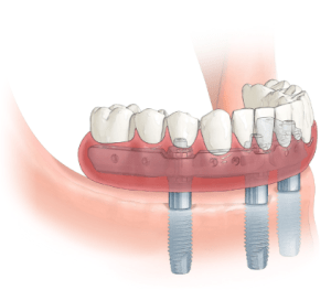 Trefoil System Full-Arch Solution