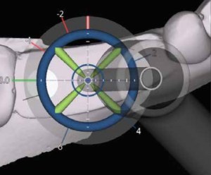 Pecision and control with Dynamic Implant Navigation X-Guide