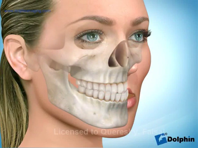 Mandibular prognathism
