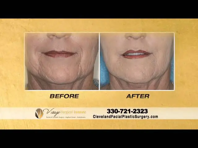 Wrinkle Reduction Treatment - Face Facts