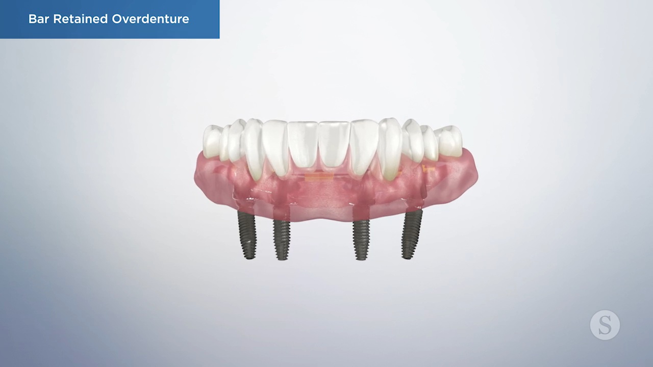 Bar Retained Overdenture Video Thumbnail