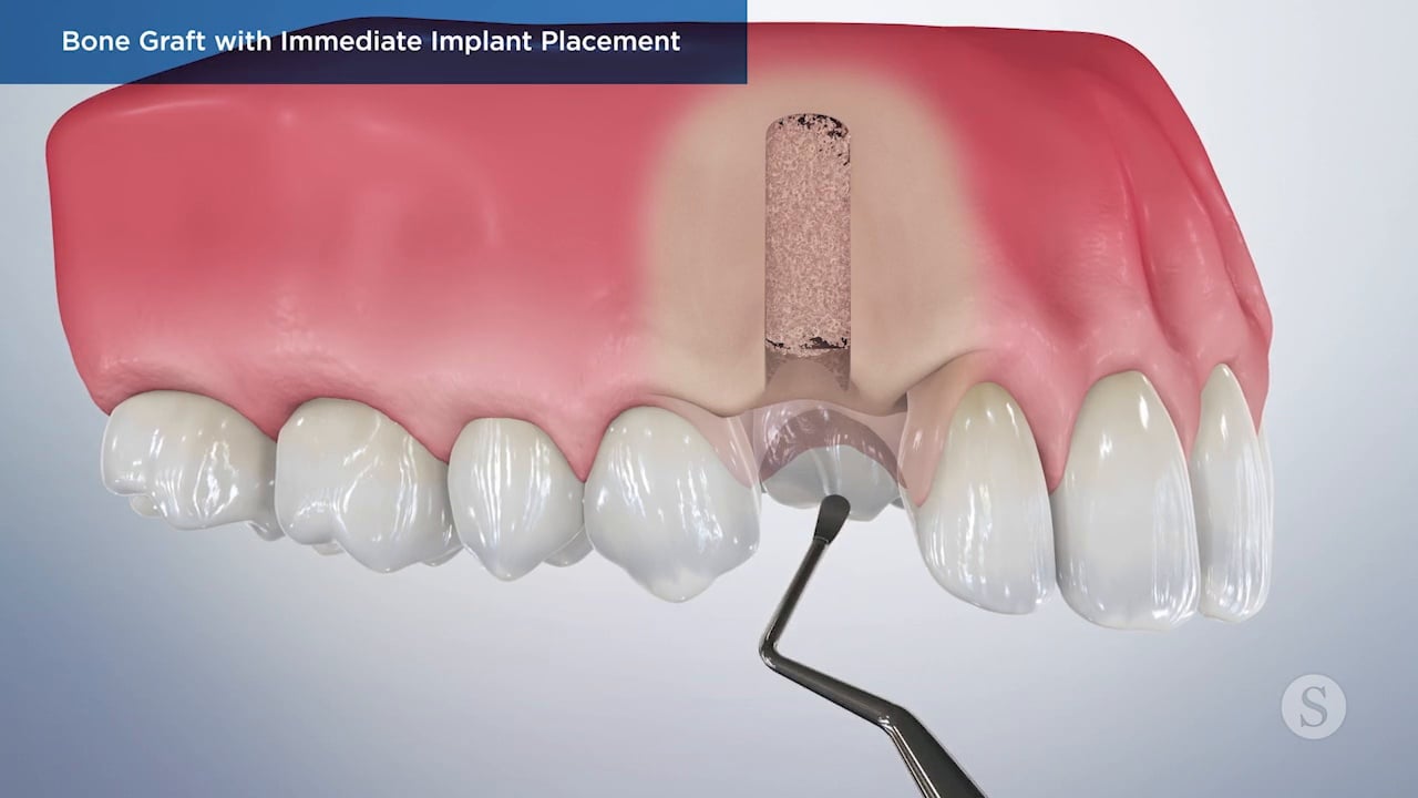 Bone Graft with Immediate Implant Placement Video Thumbnail