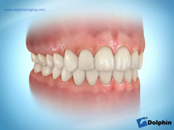 Braces