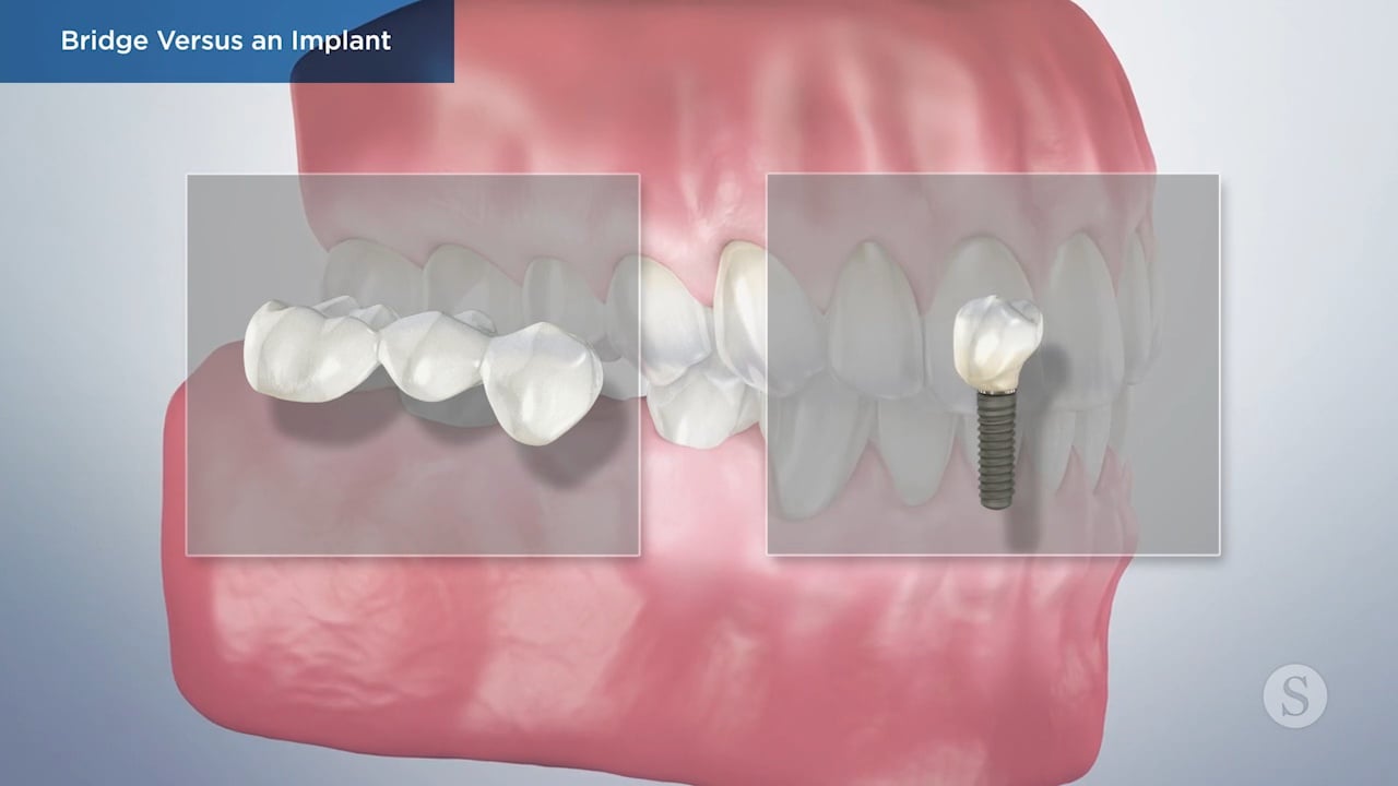 Bridge vs Implant Video Thumbnail