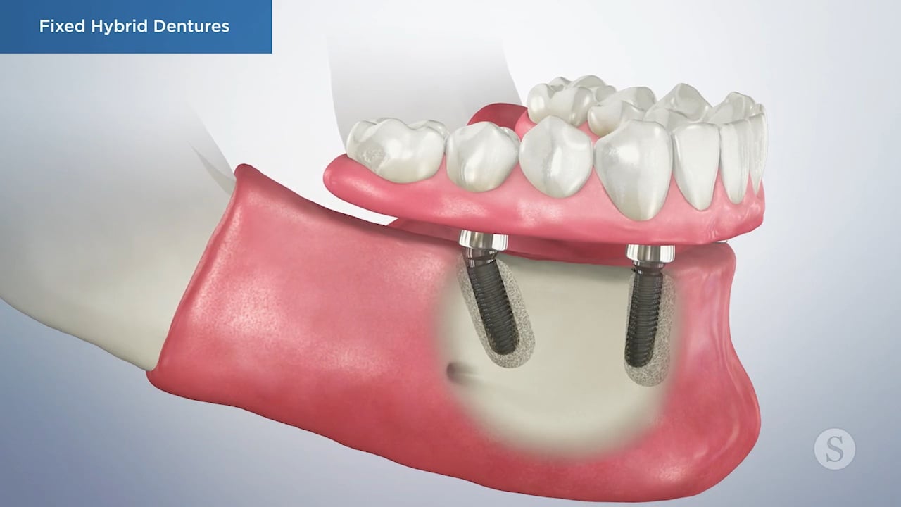 Fixed Hybrid Dentures Video Thumbnail