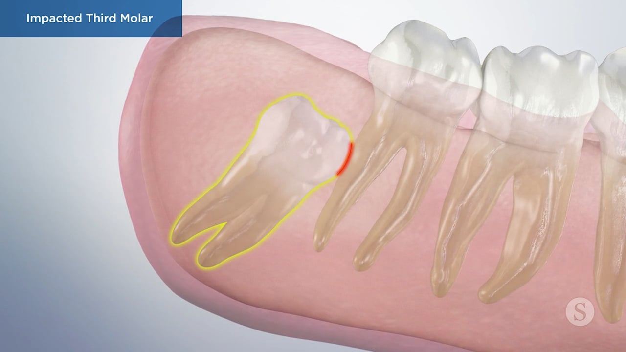 Impacted Third Molar Video Thumbnail