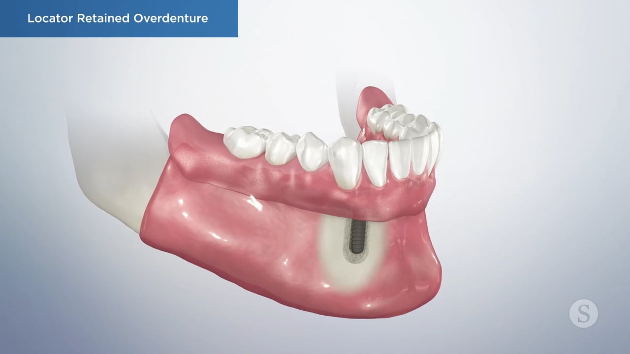 Locator Retained Overdenture Video Thumbnail
