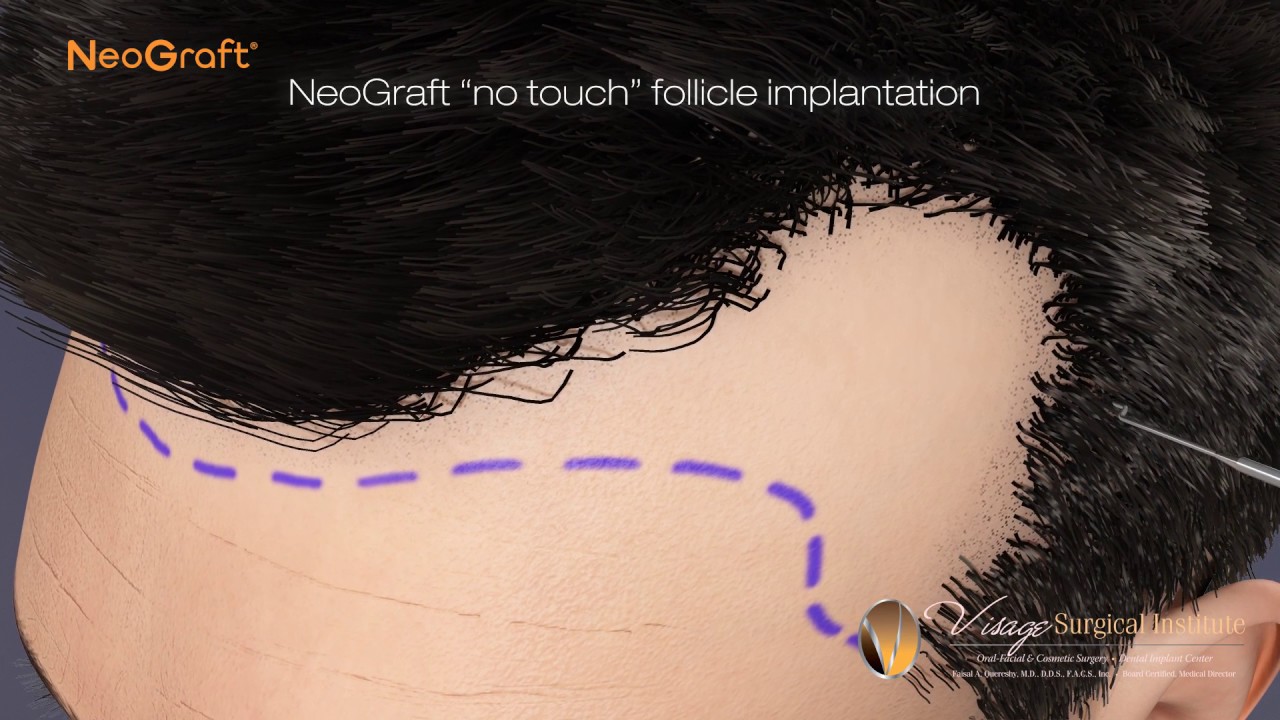 NeoGraft Hair Restoration Video Thumbnail