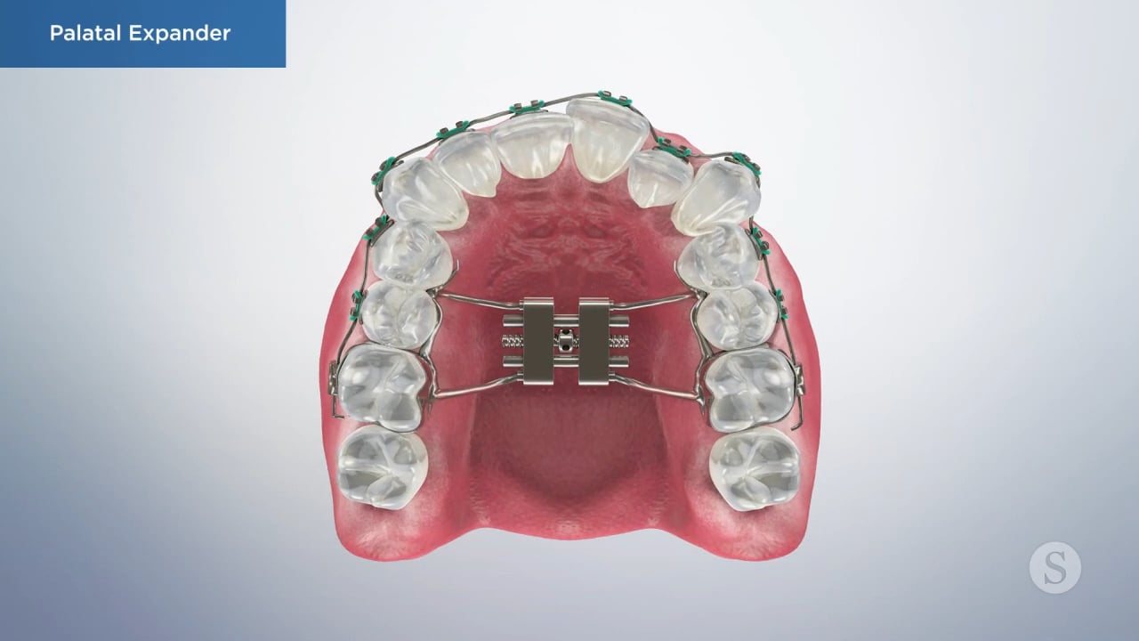 Palatal Expander