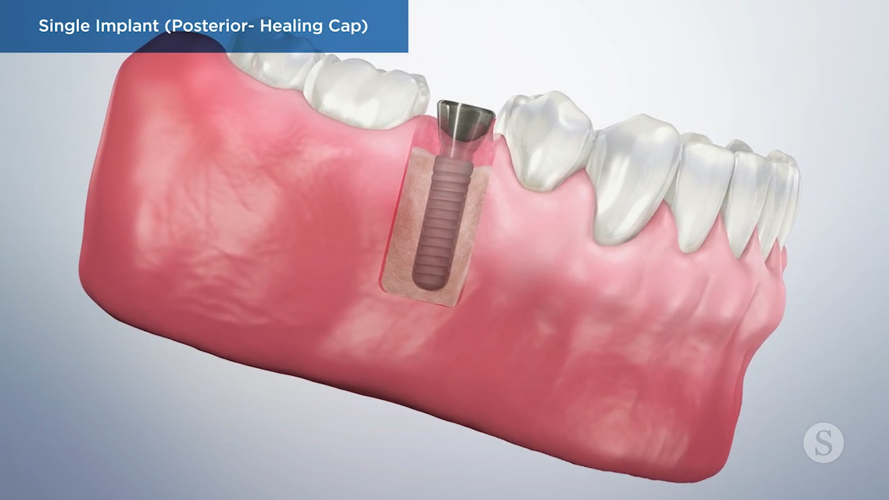 Single Implant Posterior Healing Cap Video Thumbnail